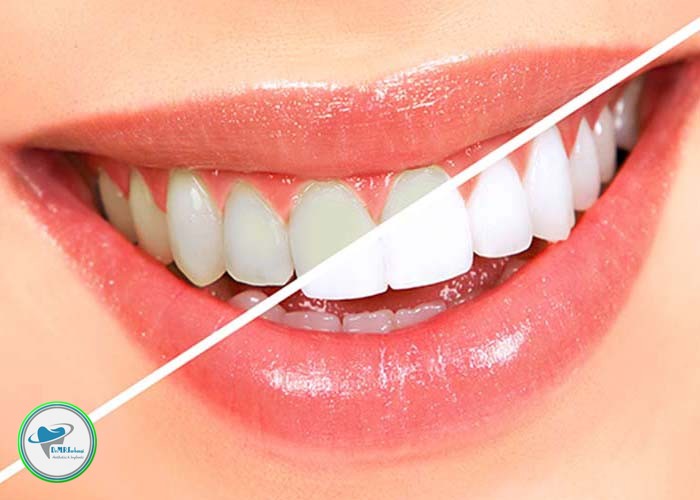 کامپوزیت دندان و بلیچینگ چه تفاوتی دارند؟